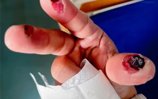 女子误踩身亡！警惕清洁剂中隐藏的“化骨水” 你家可能也有 ！