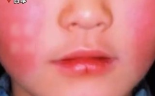 日本“苹果病”流行达到历史顶点：从双颊开始形成网状红斑 !